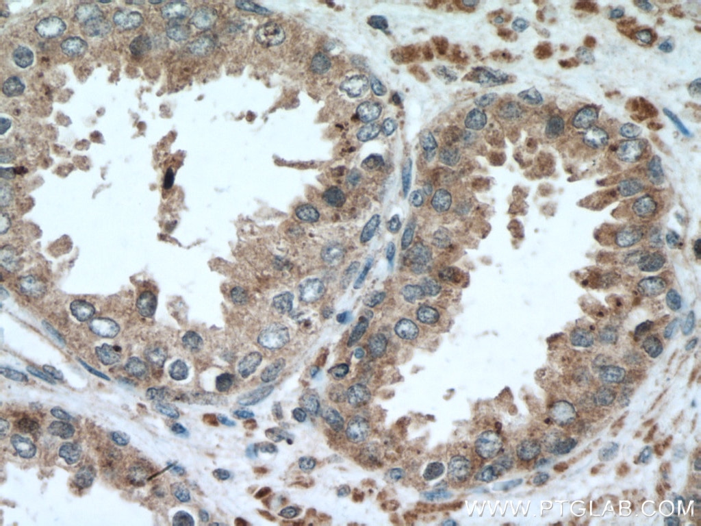 IHC staining of human prostate cancer using 66756-1-Ig