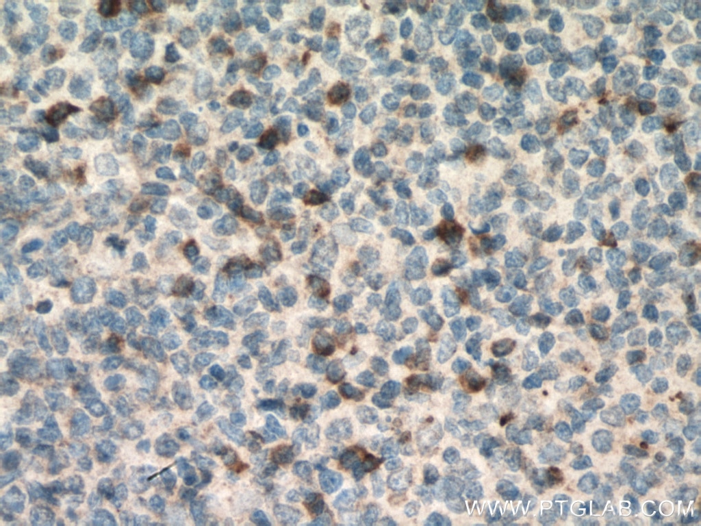 Immunohistochemistry (IHC) staining of human tonsillitis tissue using TRAIL Monoclonal antibody (66756-1-Ig)