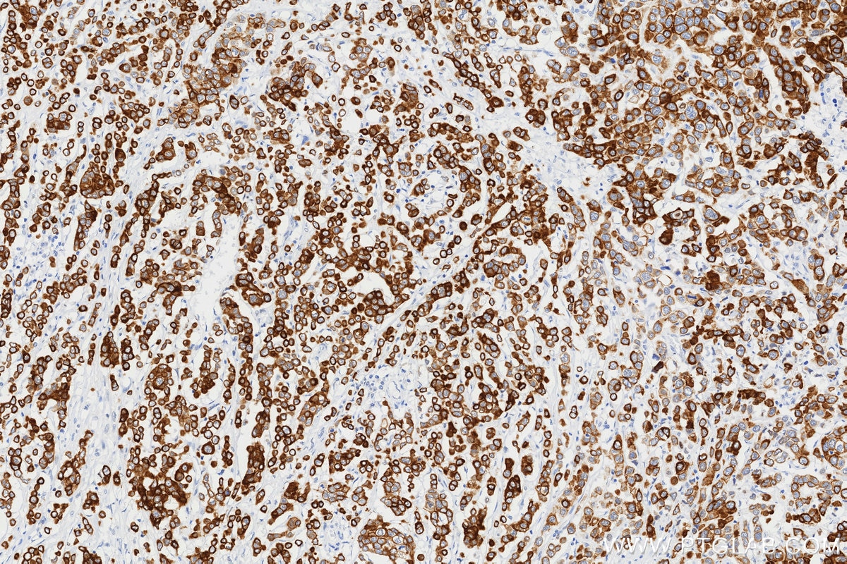 Immunohistochemistry (IHC) staining of human breast cancer tissue using TRAIP Recombinant monoclonal antibody (86808-1-RR)