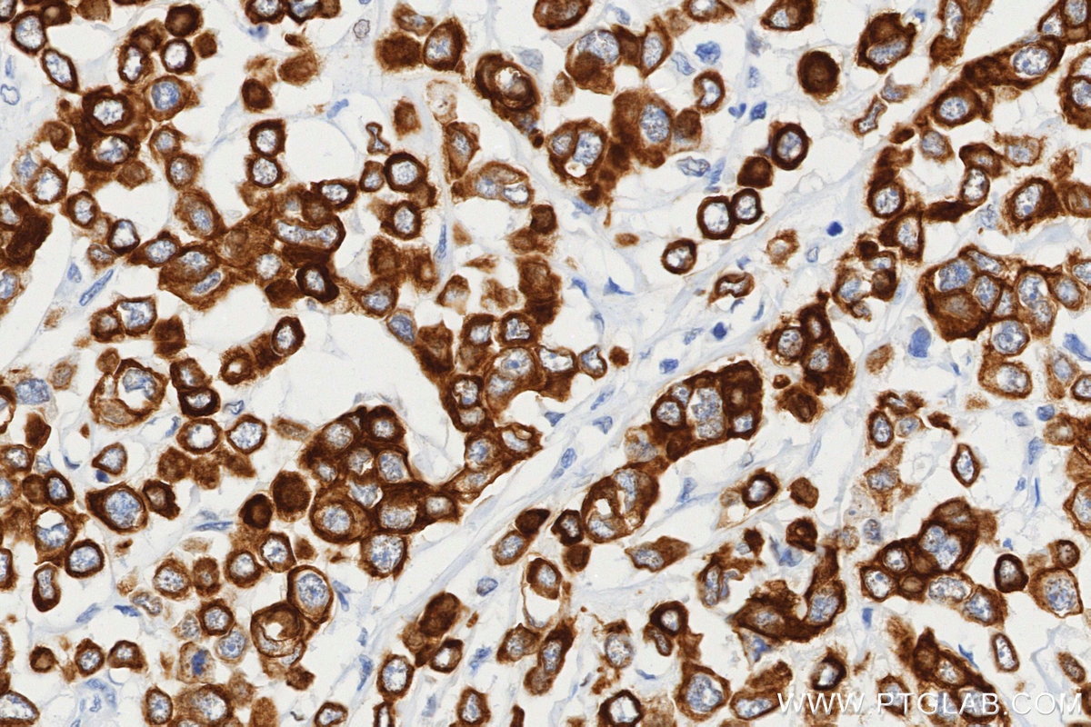 Immunohistochemistry (IHC) staining of human breast cancer tissue using TRAIP Recombinant monoclonal antibody (86808-1-RR)