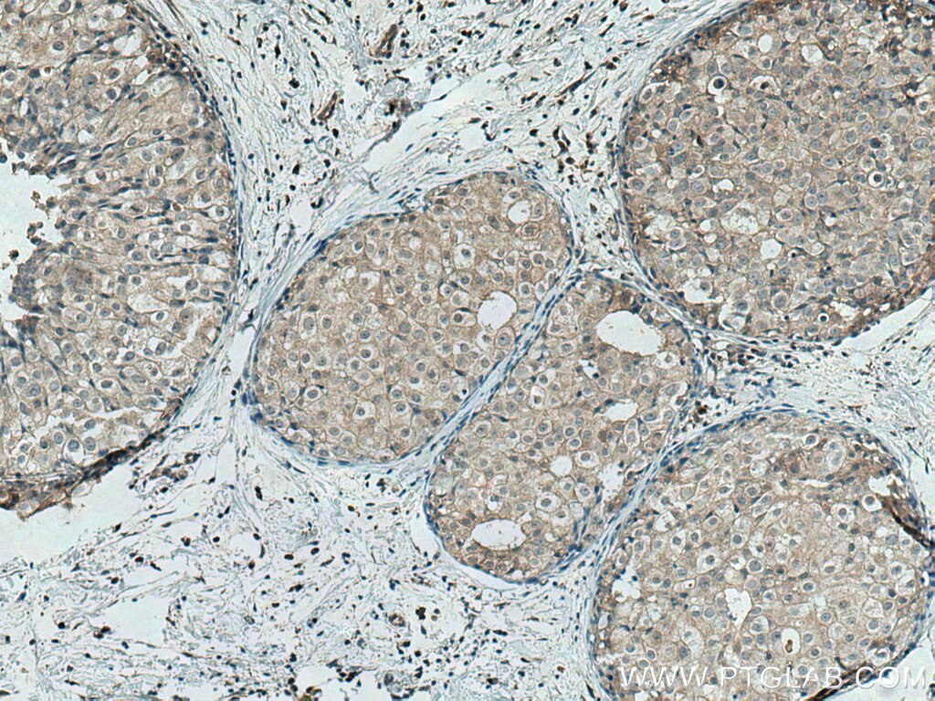 Immunohistochemistry (IHC) staining of human breast cancer tissue using TRAK1 Polyclonal antibody (13987-1-AP)