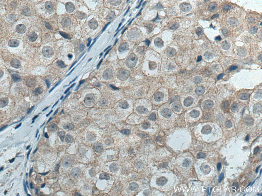 Immunohistochemistry (IHC) staining of human breast cancer tissue using TRAK1 Polyclonal antibody (13987-1-AP)