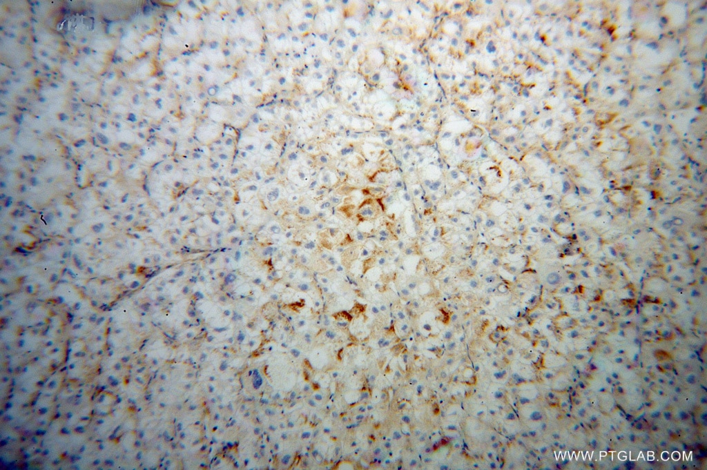 Immunohistochemistry (IHC) staining of human liver cancer tissue using TRAK2 Polyclonal antibody (13770-1-AP)