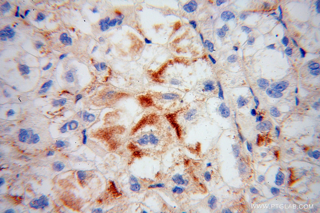 Immunohistochemistry (IHC) staining of human liver cancer tissue using TRAK2 Polyclonal antibody (13770-1-AP)