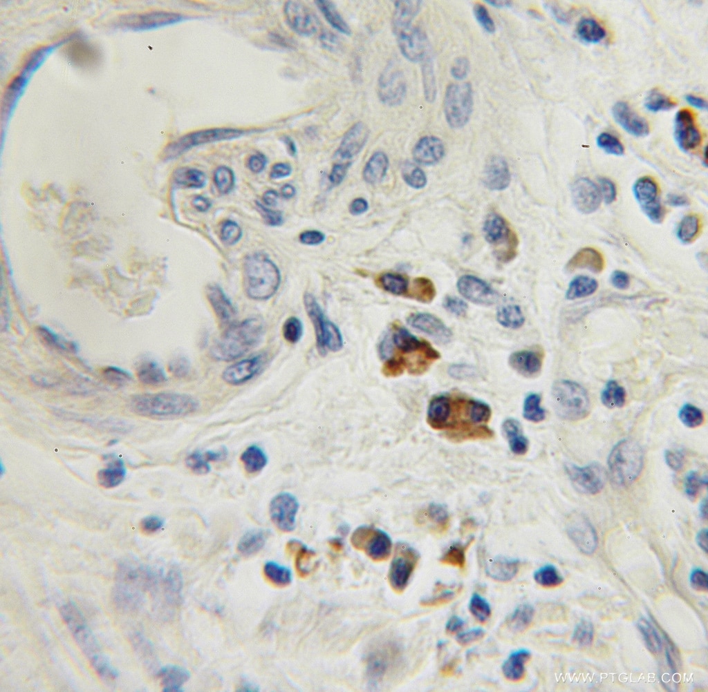 Immunohistochemistry (IHC) staining of human prostate cancer tissue using TRAM1 Polyclonal antibody (12705-1-AP)