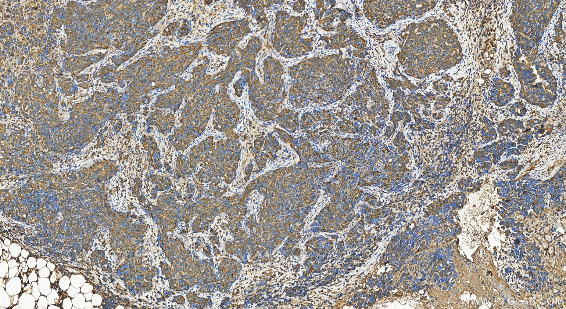 IHC staining of human ovary cancer using 27583-1-AP Immunohistochemistry (IHC) staining of human ovary cancer tissue using TRANK1 Polyclonal antibody (27583-1-AP)