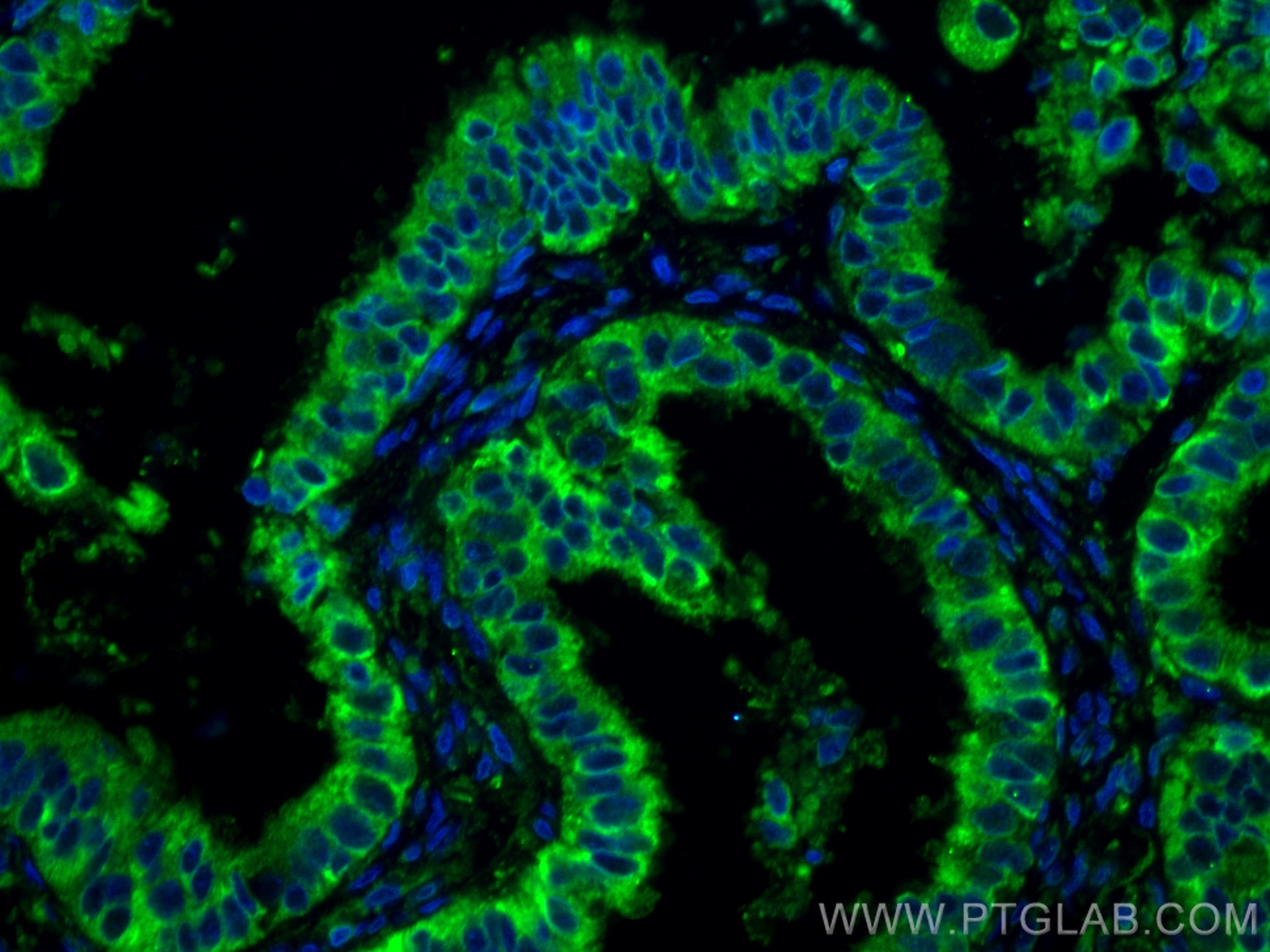 Immunofluorescence (IF) / fluorescent staining of human ovary tumor tissue using TRAPA/SSR1 Monoclonal antibody (67925-1-Ig)