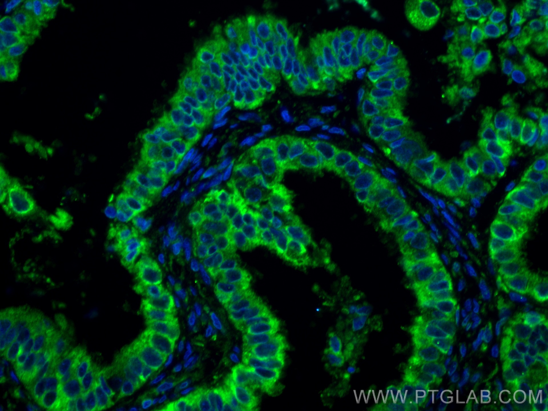 Immunofluorescence (IF) / fluorescent staining of human ovary tumor tissue using TRAPA/SSR1 Monoclonal antibody (67925-1-Ig)