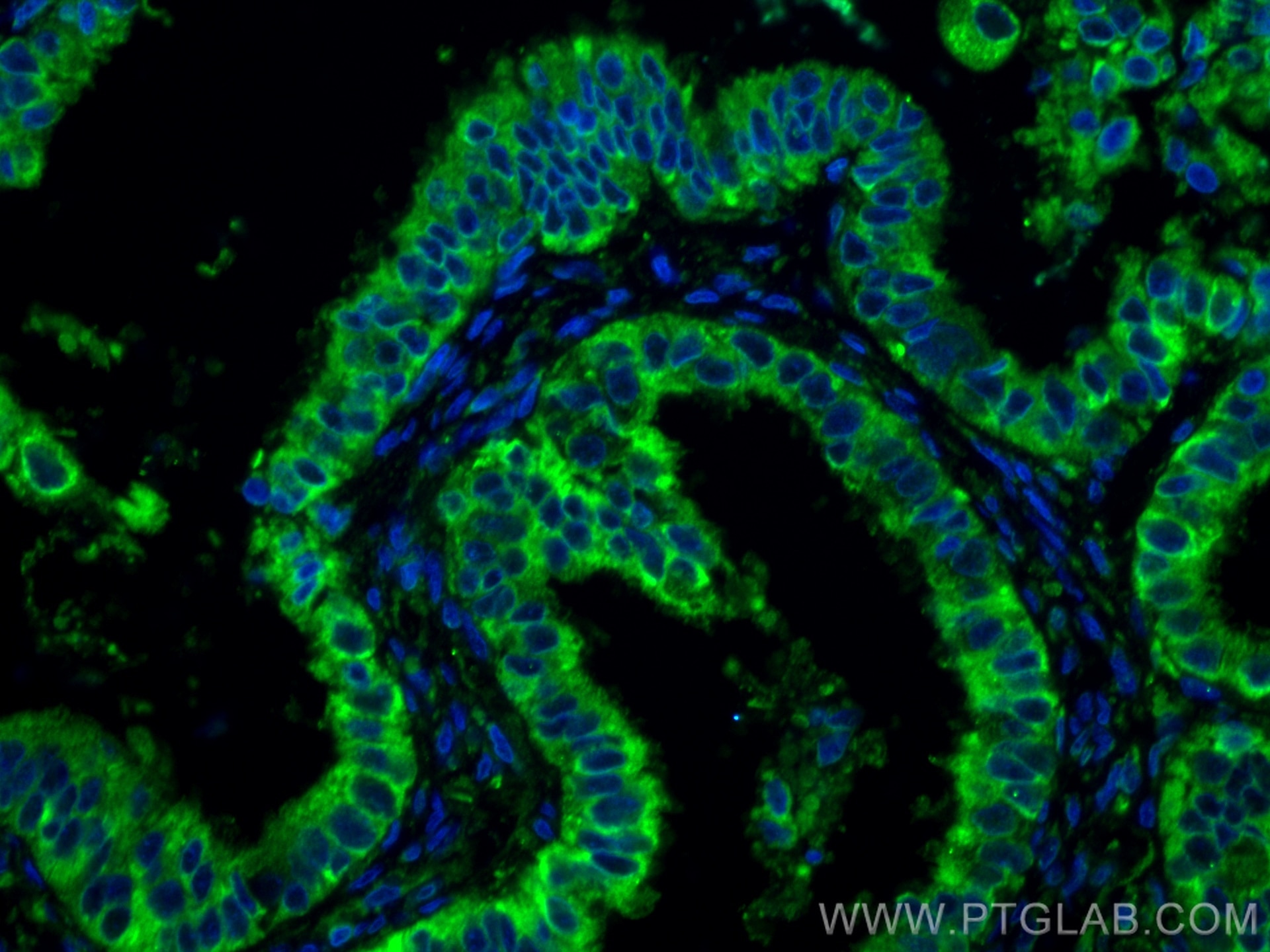 IF Staining of human ovary tumor using 67925-1-Ig