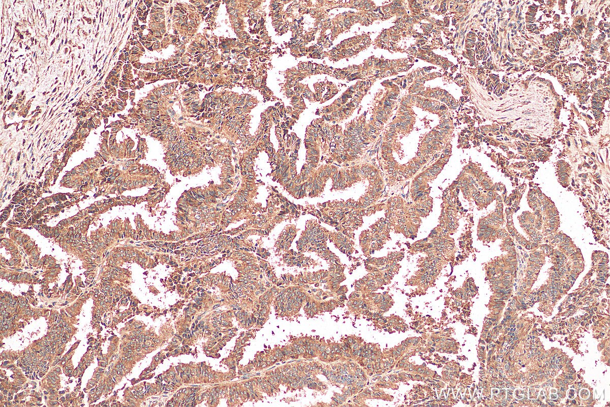 IHC staining of human ovary tumor using 67925-1-Ig