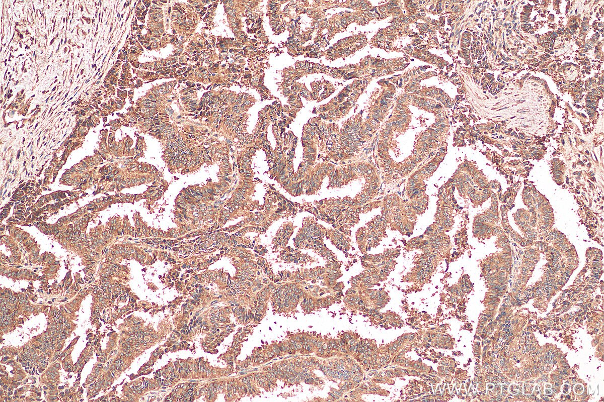 Immunohistochemistry (IHC) staining of human ovary tumor tissue using TRAPA/SSR1 Monoclonal antibody (67925-1-Ig)