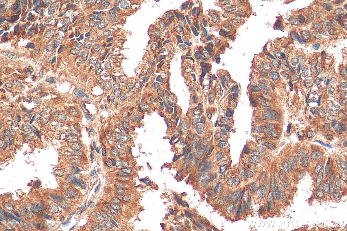 Immunohistochemistry (IHC) staining of human ovary tumor tissue using TRAPA/SSR1 Monoclonal antibody (67925-1-Ig)