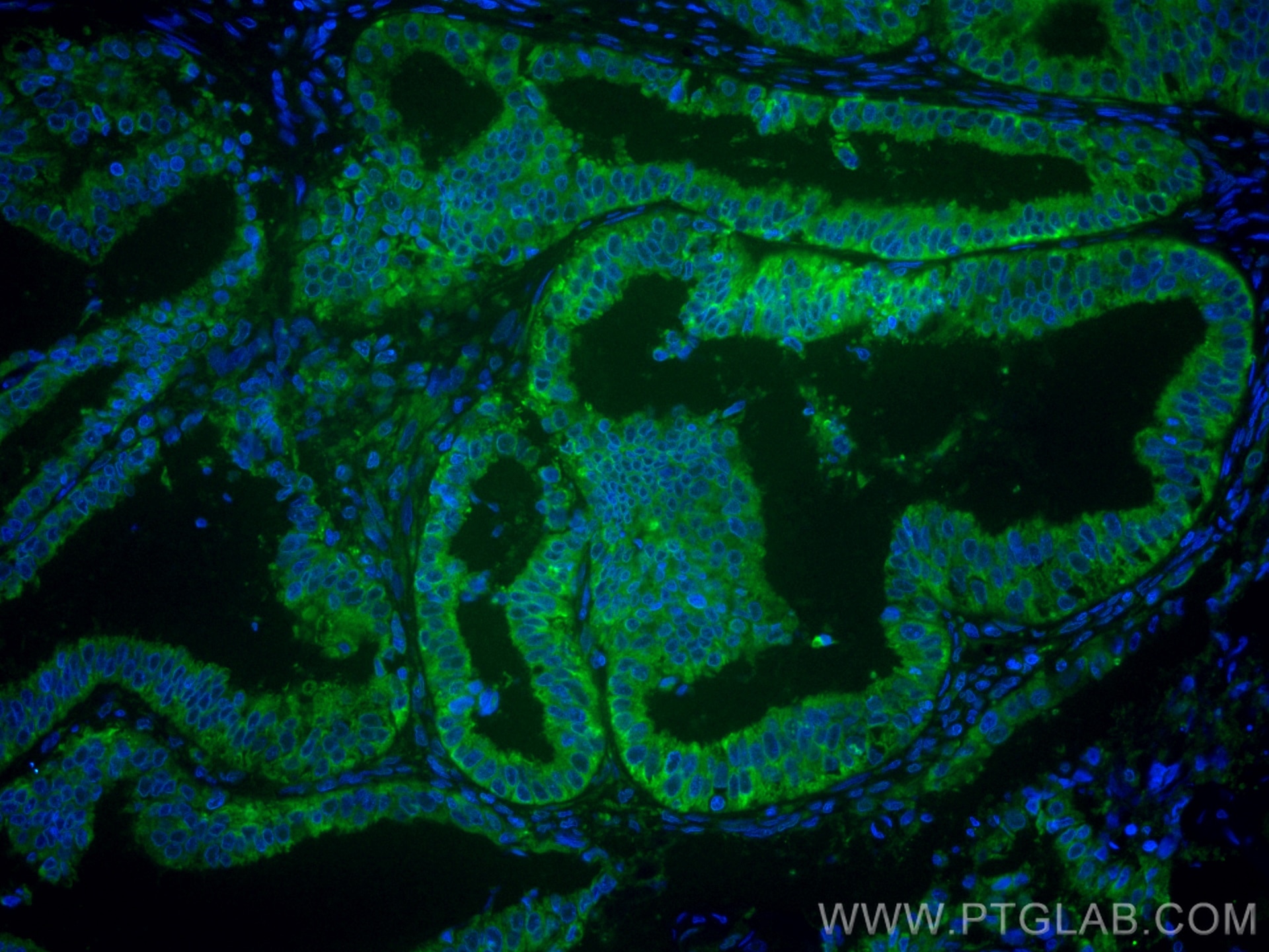 Immunofluorescence (IF) / fluorescent staining of human ovary tumor tissue using CoraLite® Plus 488-conjugated TRAPA/SSR1 Monoclona (CL488-67925)