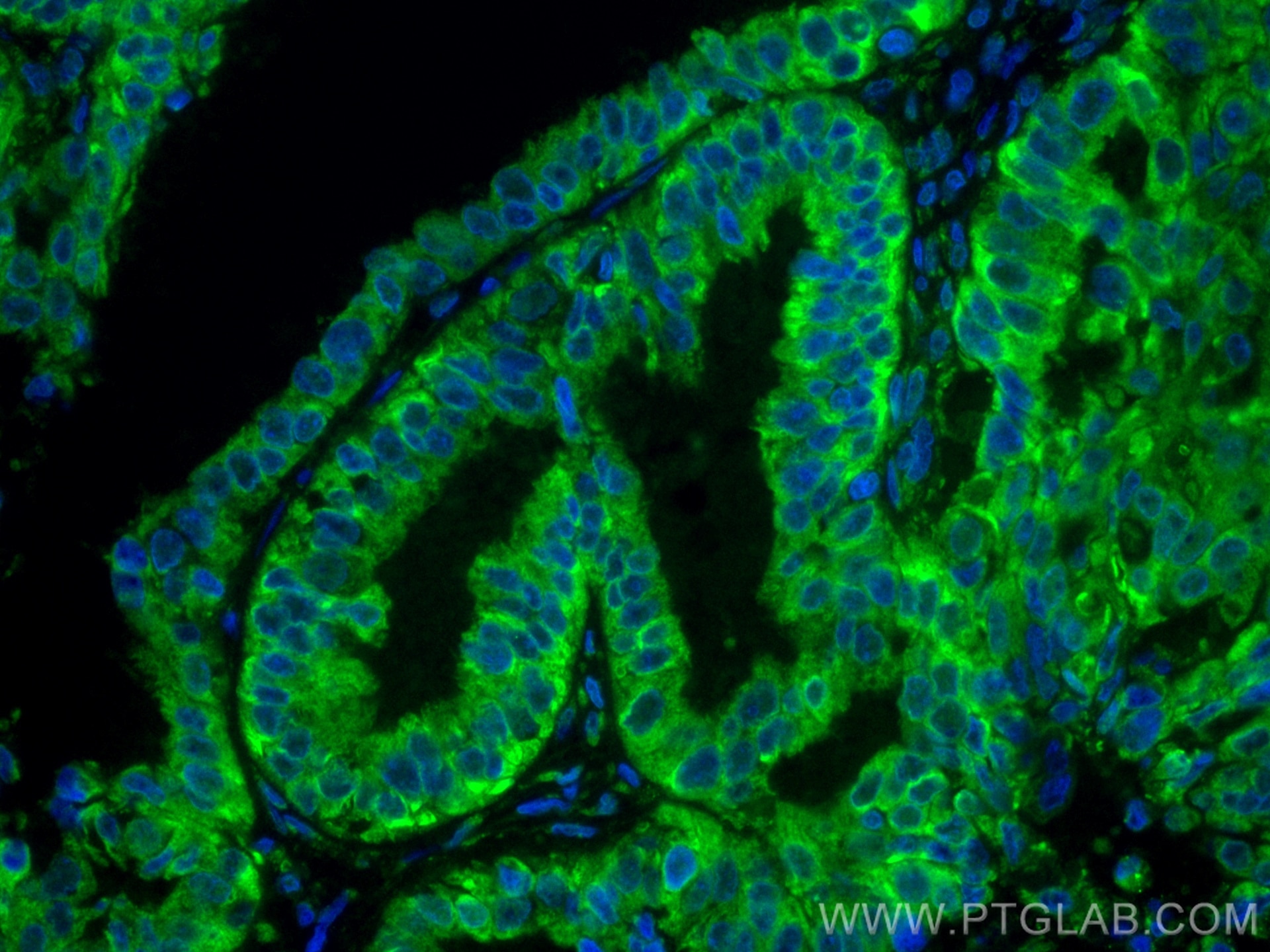 Immunofluorescence (IF) / fluorescent staining of human ovary tumor tissue using CoraLite® Plus 488-conjugated TRAPA/SSR1 Monoclona (CL488-67925)