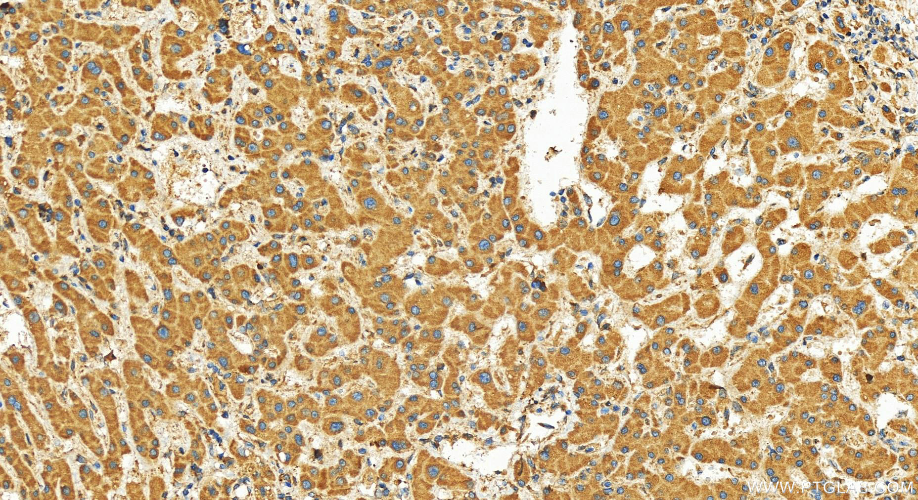 Immunohistochemistry (IHC) staining of human intrahepatic cholangiocarcinoma tissue using TRAPPC11 Polyclonal antibody (27774-1-AP)