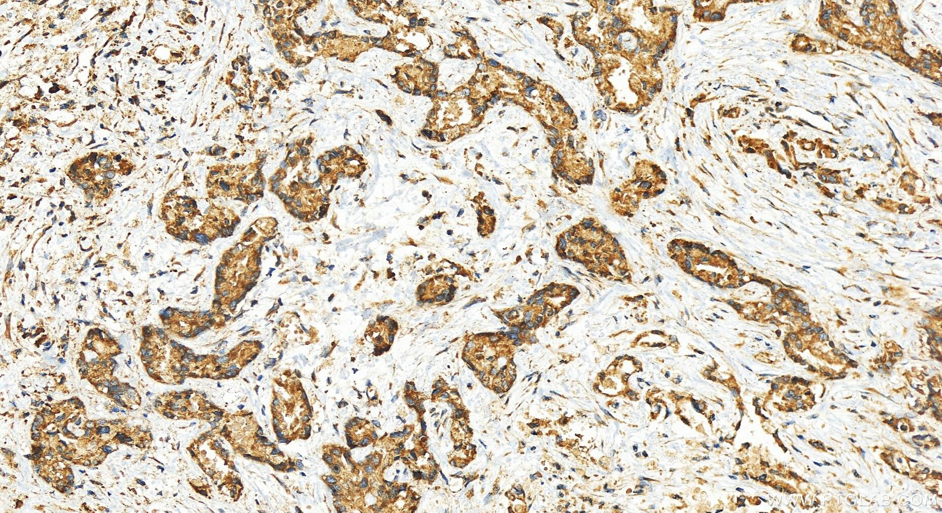 Immunohistochemistry (IHC) staining of human intrahepatic cholangiocarcinoma tissue using TRAPPC11 Polyclonal antibody (27774-1-AP)