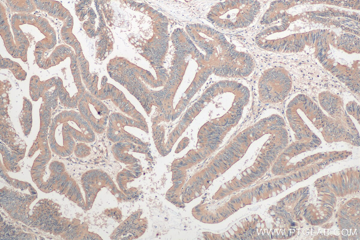 Immunohistochemistry (IHC) staining of human colon cancer tissue using TRAPPC4 Polyclonal antibody (12074-1-AP)