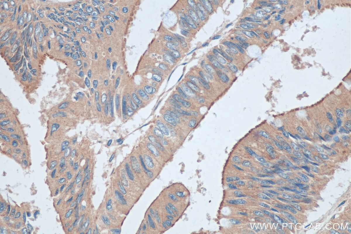 Immunohistochemistry (IHC) staining of human colon cancer tissue using TRAPPC4 Polyclonal antibody (12074-1-AP)