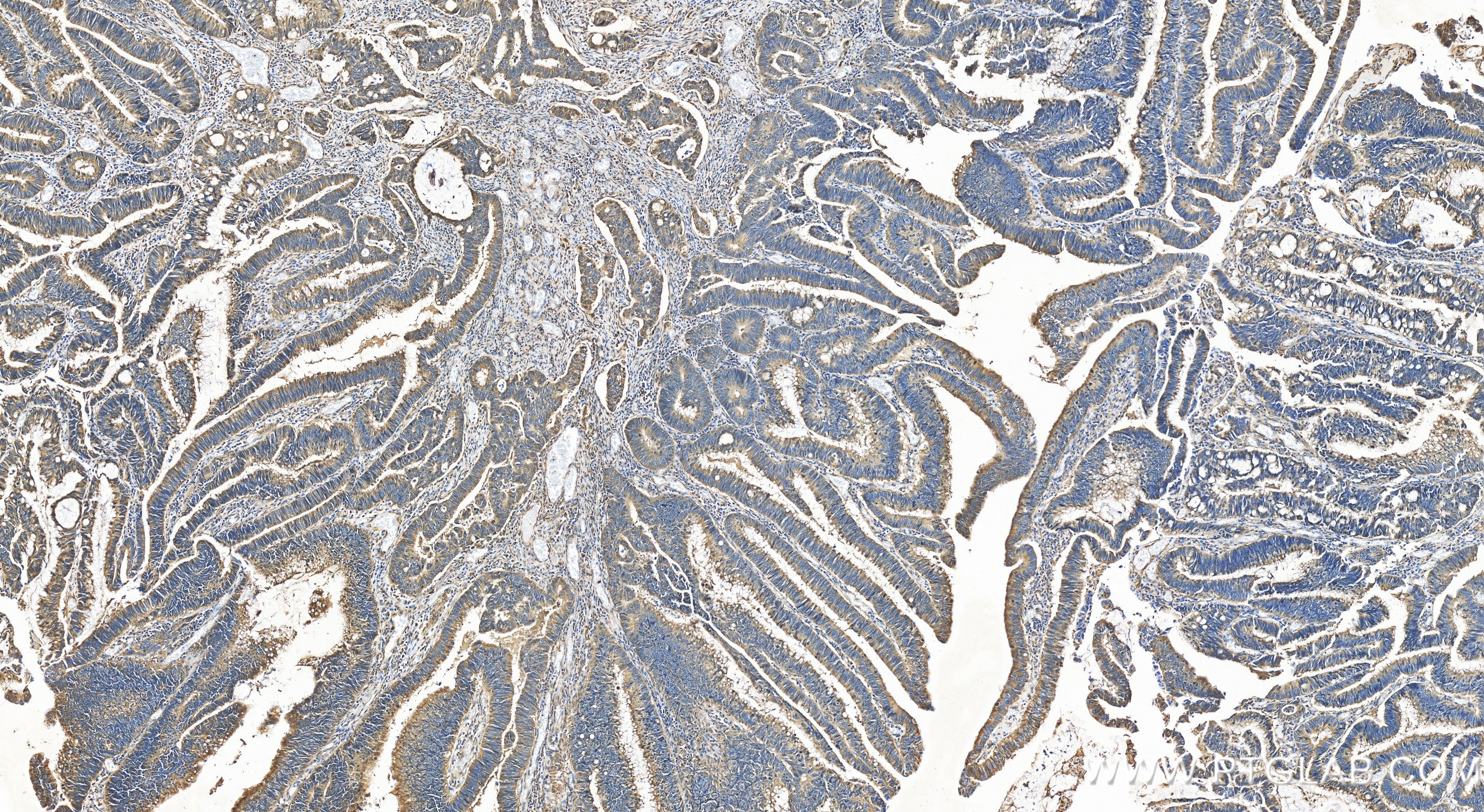 Immunohistochemistry (IHC) staining of human colon cancer tissue using TRAPPC4 Recombinant antibody (84119-3-RR)