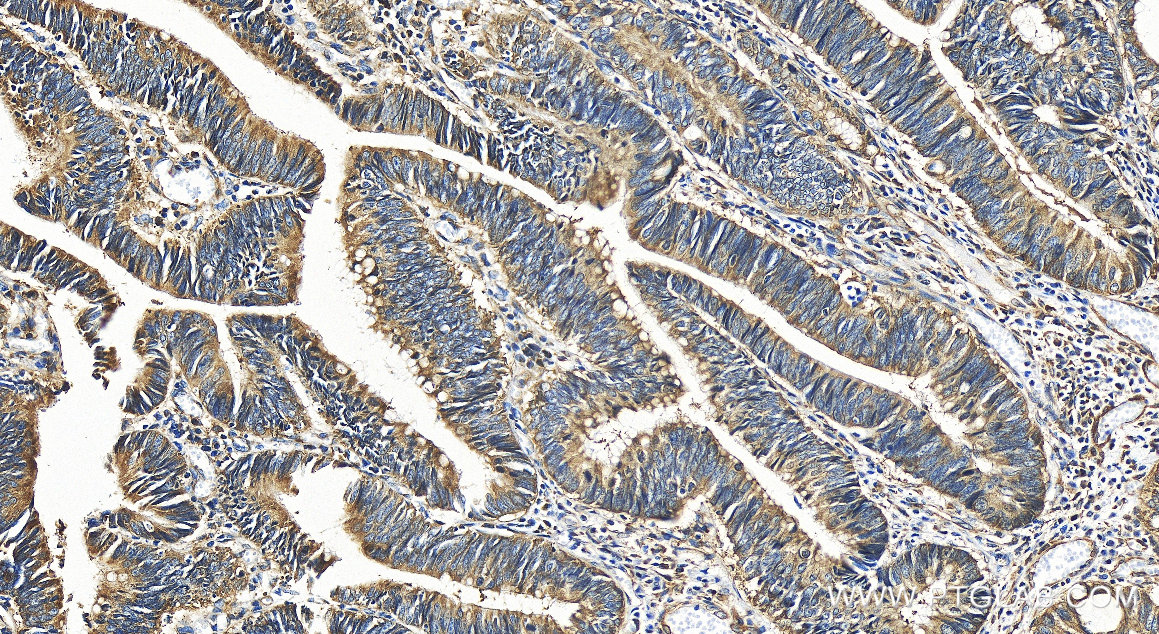 Immunohistochemistry (IHC) staining of human colon cancer tissue using TRAPPC4 Recombinant antibody (84119-3-RR)
