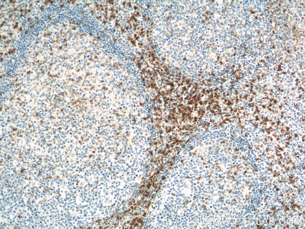Immunohistochemistry (IHC) staining of human tonsillitis tissue using TRAT1 Polyclonal antibody (13279-1-AP)