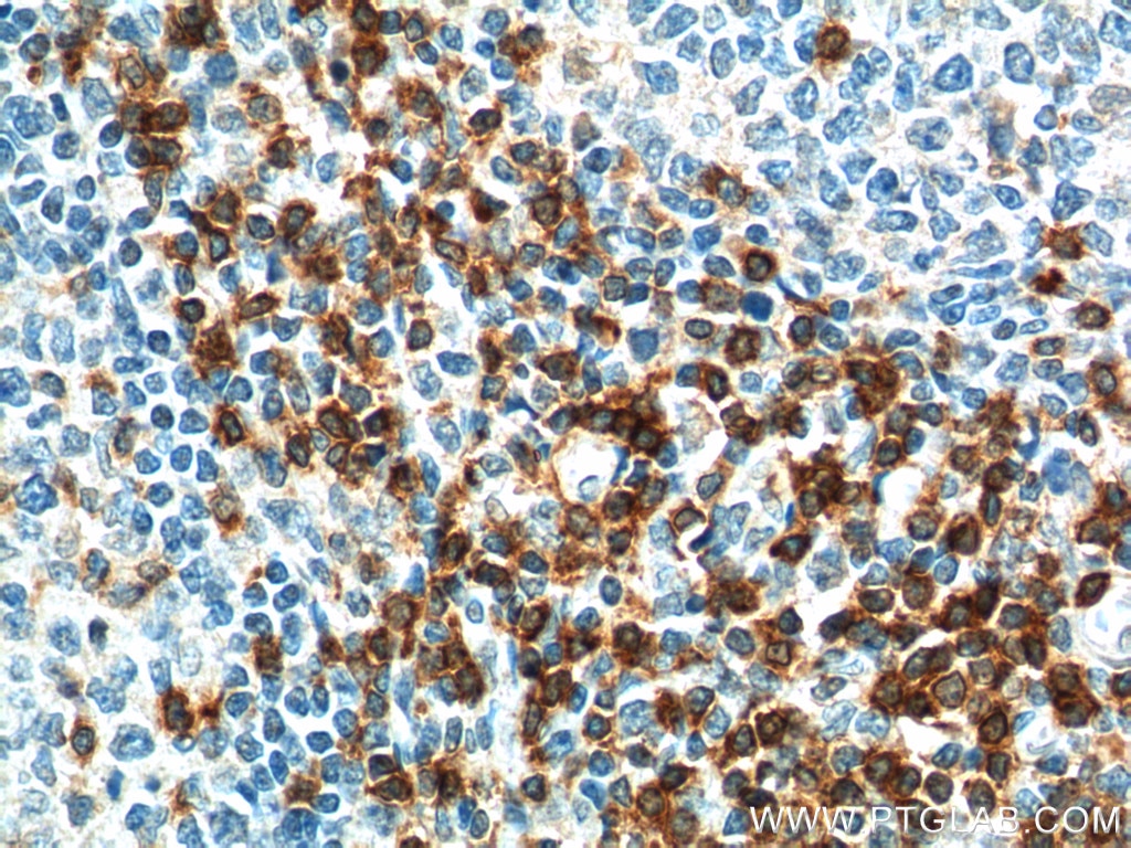 Immunohistochemistry (IHC) staining of human tonsillitis tissue using TRAT1 Polyclonal antibody (13279-1-AP)