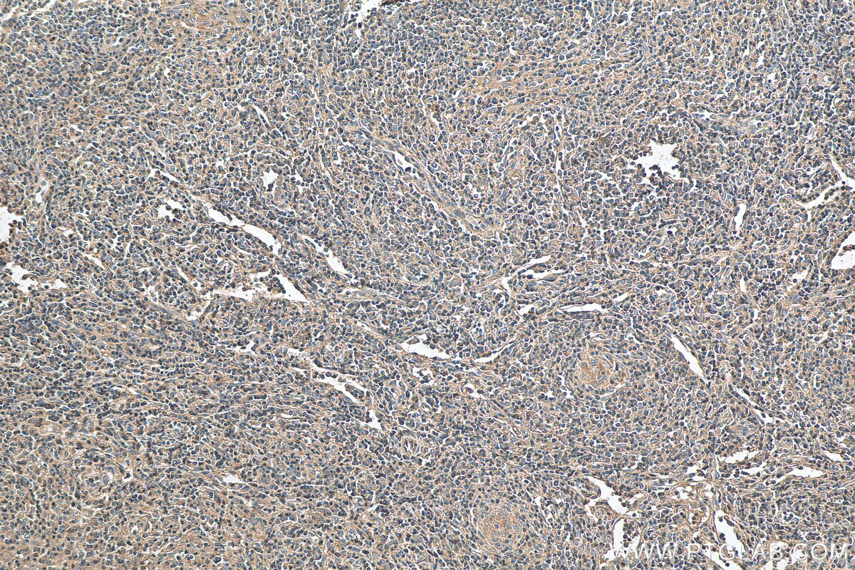 Immunohistochemistry (IHC) staining of human lymphoma tissue using TRAV20 Polyclonal antibody (13132-1-AP)