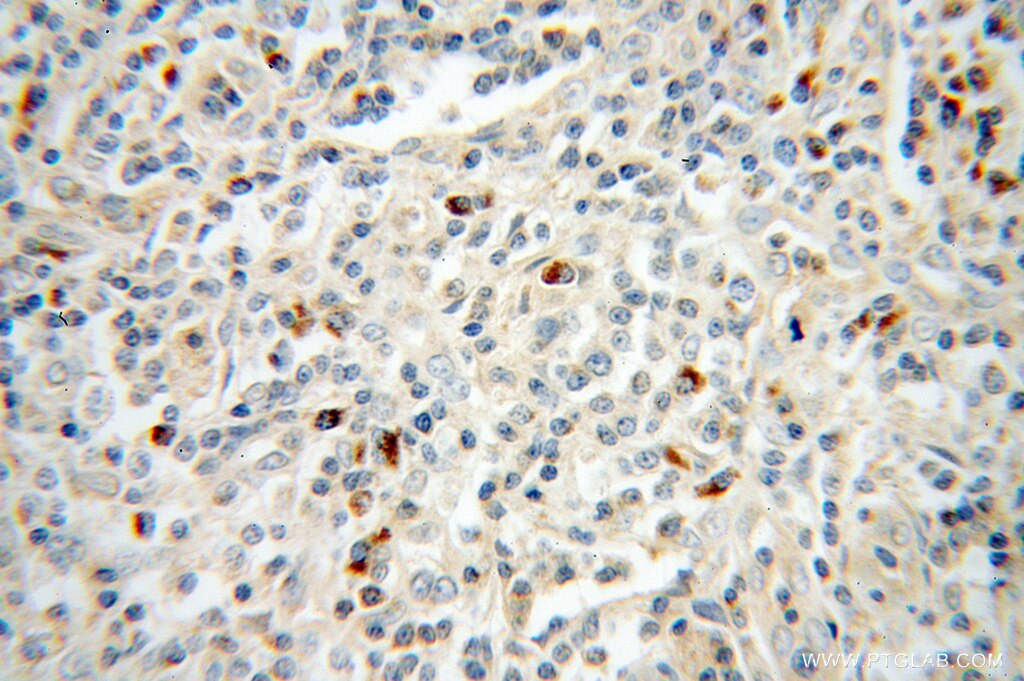 Immunohistochemistry (IHC) staining of human lymphoma tissue using TRAV20 Polyclonal antibody (13132-1-AP)
