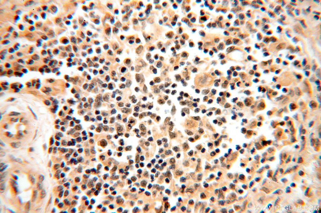 Immunohistochemistry (IHC) staining of human spleen tissue using TRBP Polyclonal antibody (15753-1-AP)