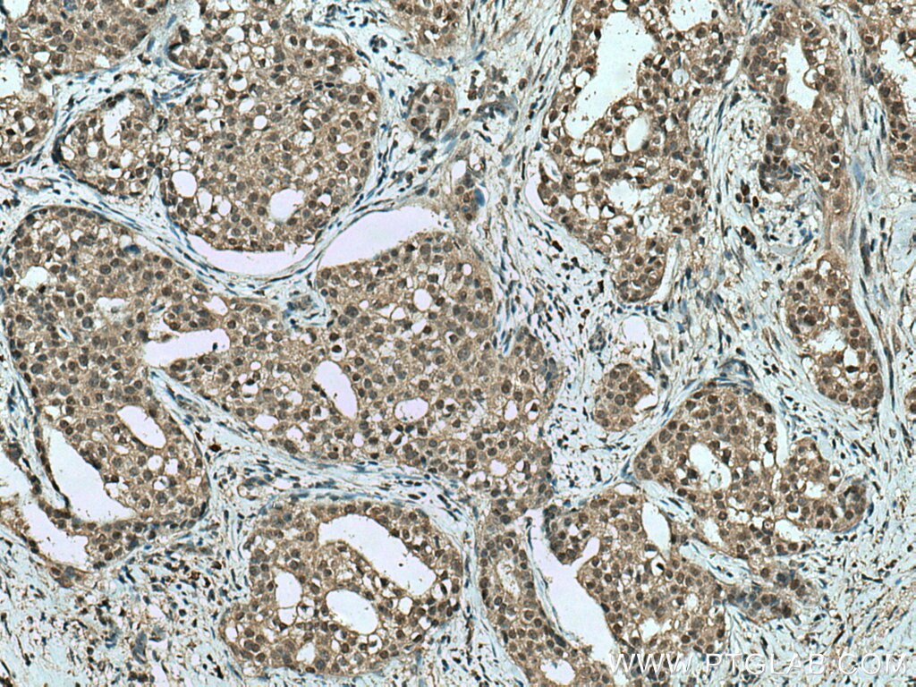 Immunohistochemistry (IHC) staining of human breast cancer tissue using TRBP Monoclonal antibody (66792-1-Ig)