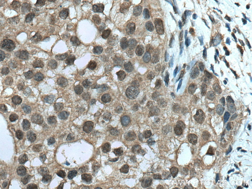 Immunohistochemistry (IHC) staining of human breast cancer tissue using TRBP Monoclonal antibody (66792-1-Ig)