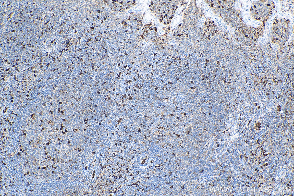 Immunohistochemistry (IHC) staining of human tonsillitis tissue using TREM1 Polyclonal antibody (11791-1-AP)
