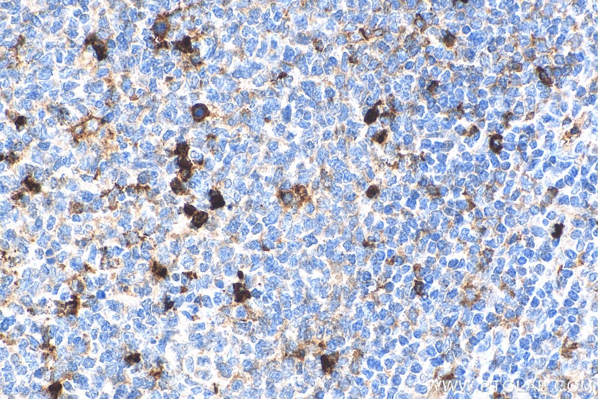 IHC staining of human tonsillitis using 11791-1-AP