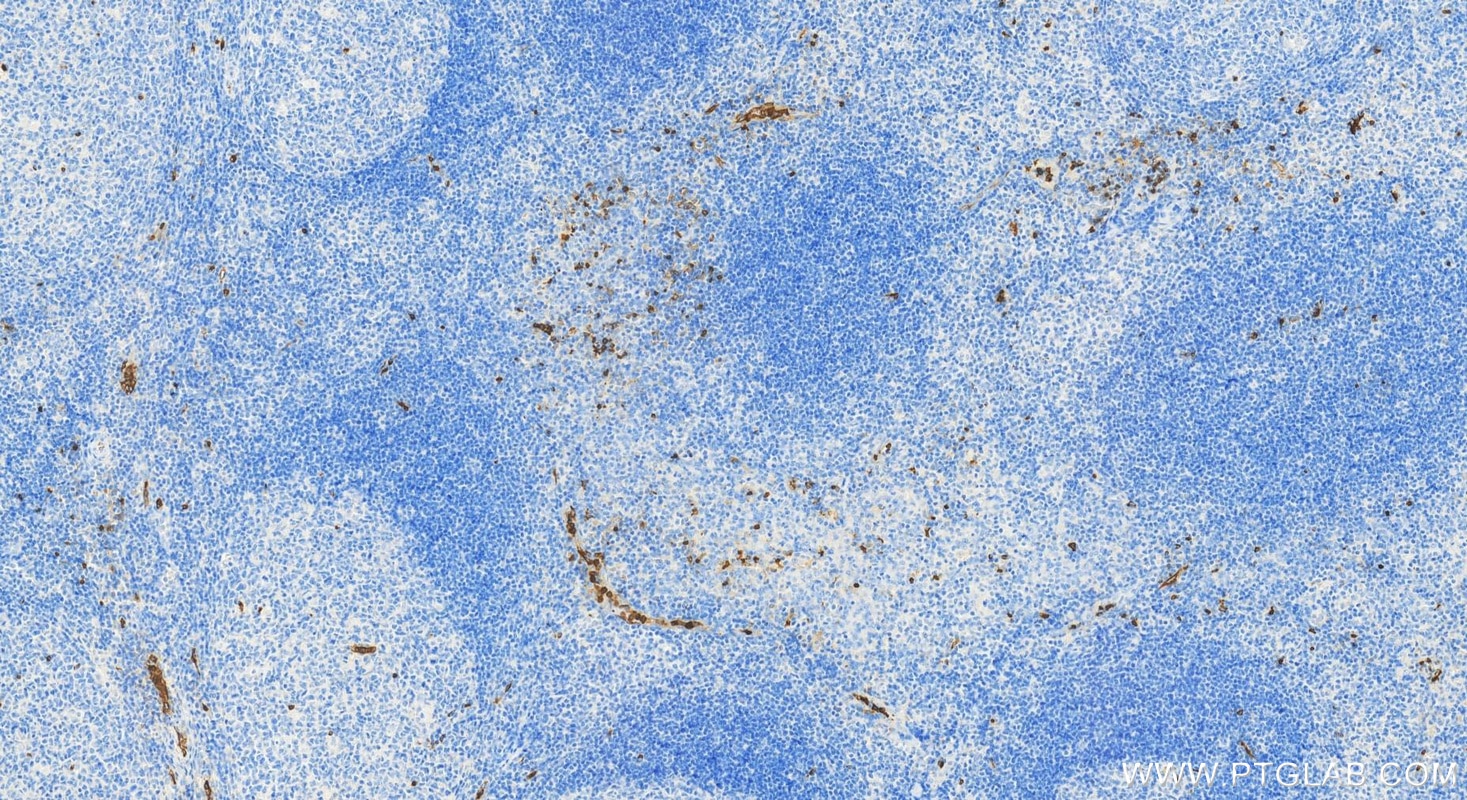 Immunohistochemistry (IHC) staining of human tonsillitis tissue using TREM-1/CD354 Polyclonal antibody (11791-1-AP)