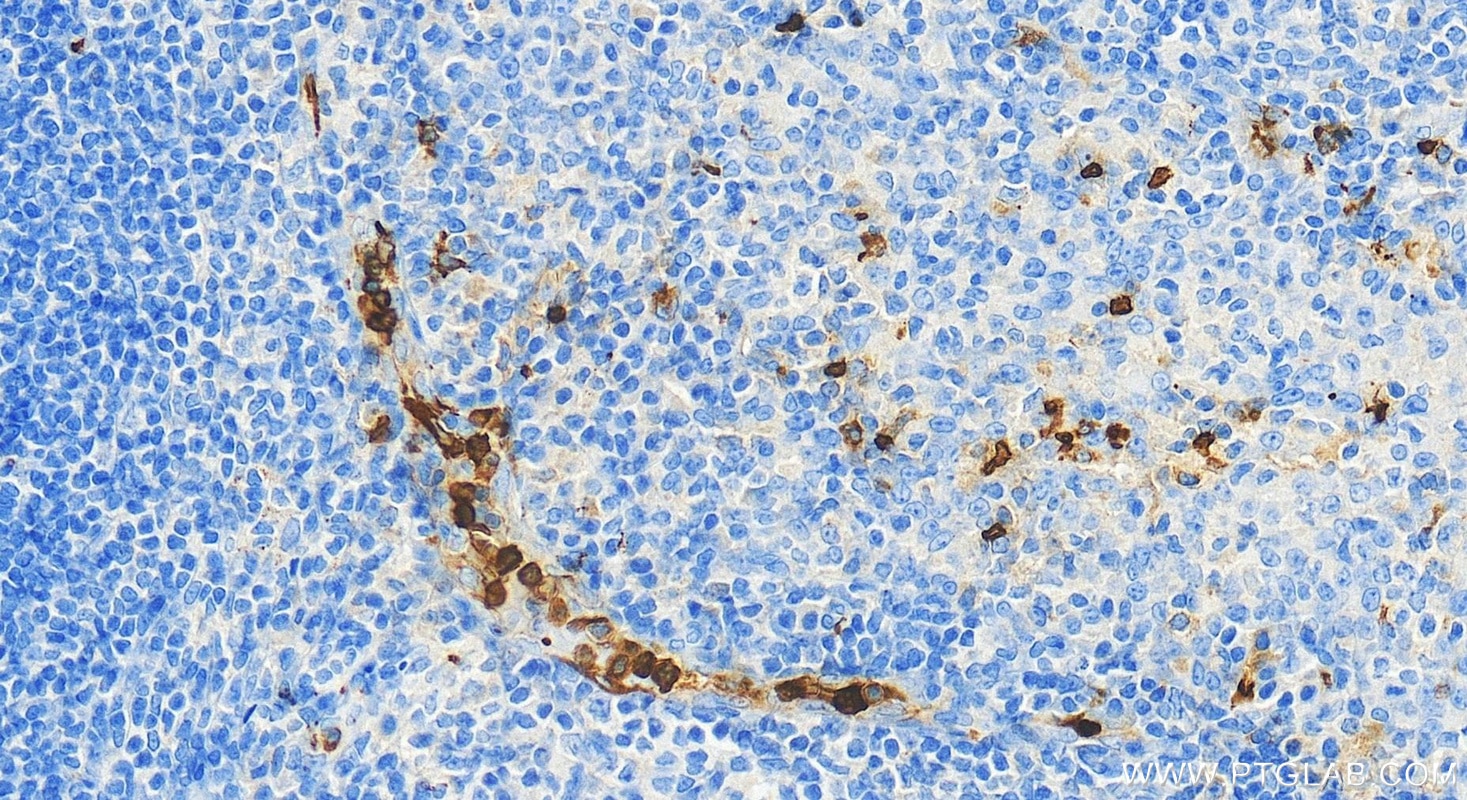 Immunohistochemistry (IHC) staining of human tonsillitis tissue using TREM-1/CD354 Polyclonal antibody (11791-1-AP)