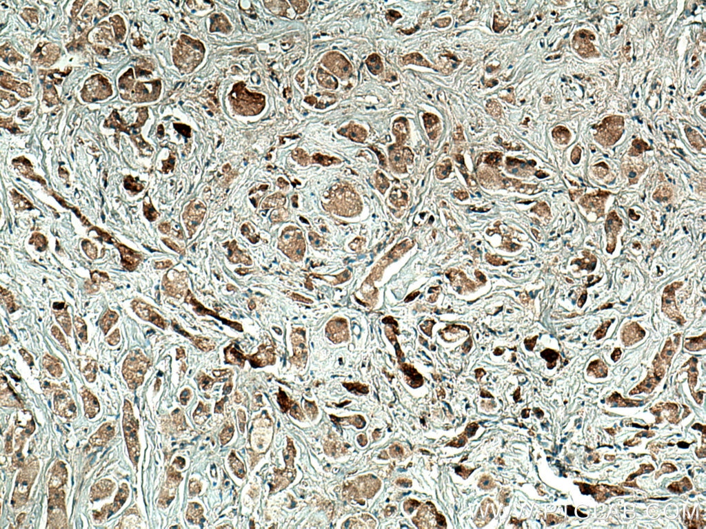 IHC staining of human breast cancer using 15351-1-AP