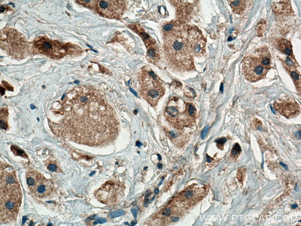 Immunohistochemistry (IHC) staining of human breast cancer tissue using TRIAP1 Polyclonal antibody (15351-1-AP)