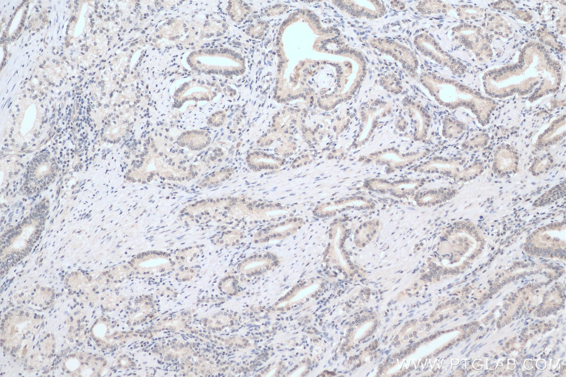 Immunohistochemistry (IHC) staining of human prostate cancer tissue using TRIB1 Polyclonal antibody (27899-1-AP)