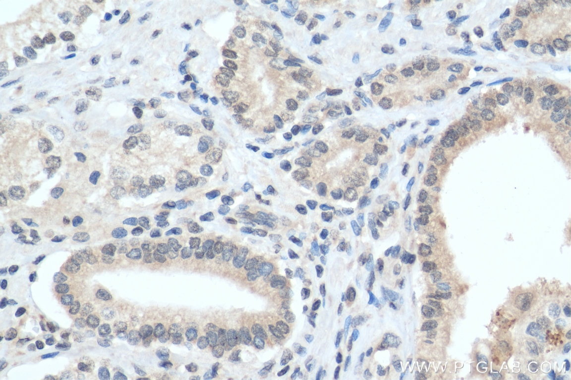 Immunohistochemistry (IHC) staining of human prostate cancer tissue using TRIB1 Polyclonal antibody (27899-1-AP)