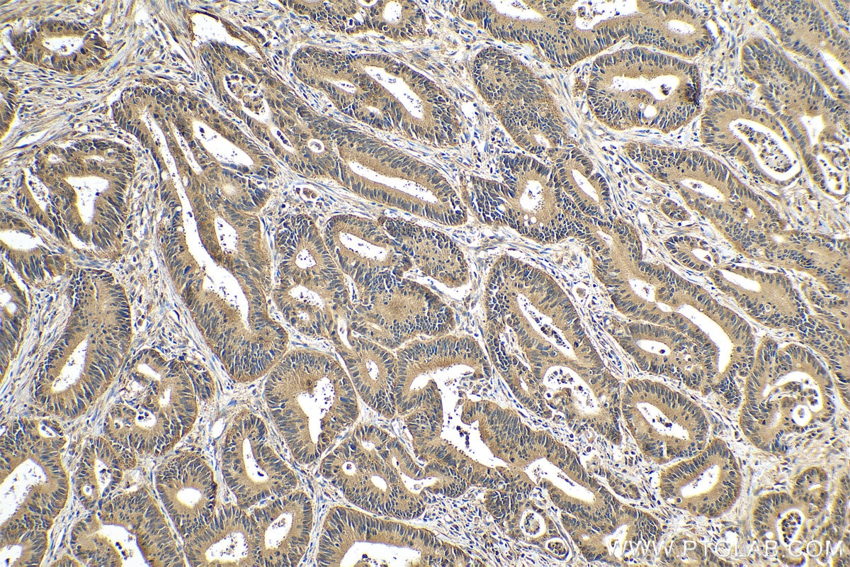 Immunohistochemistry (IHC) staining of human colon cancer tissue using TRIM11 Polyclonal antibody (10851-1-AP)