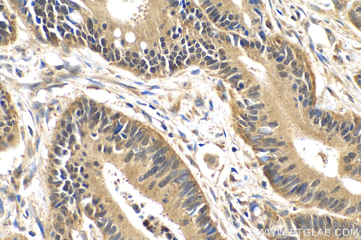 Immunohistochemistry (IHC) staining of human colon cancer tissue using TRIM11 Polyclonal antibody (10851-1-AP)