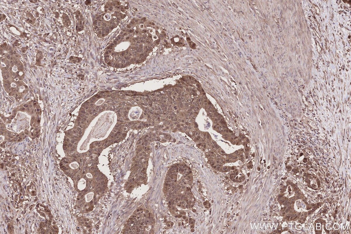 Immunohistochemistry (IHC) staining of human stomach cancer tissue using TRIM11 Polyclonal antibody (10851-1-AP)