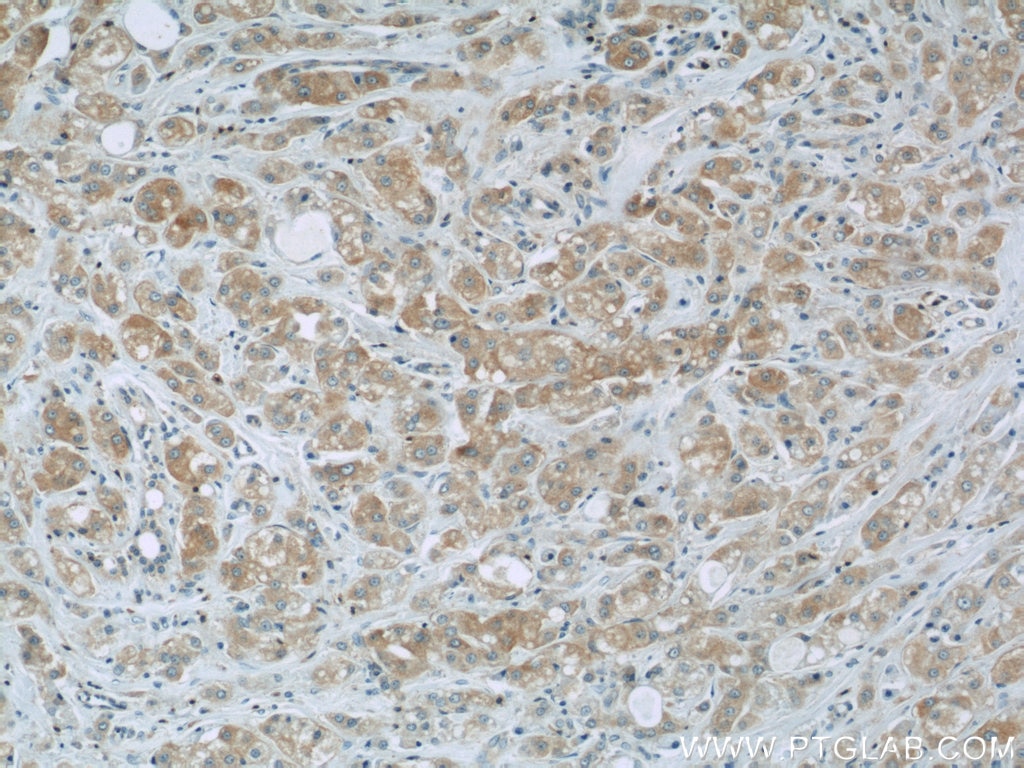 Immunohistochemistry (IHC) staining of human breast cancer tissue using RFP2 Polyclonal antibody (22021-1-AP)