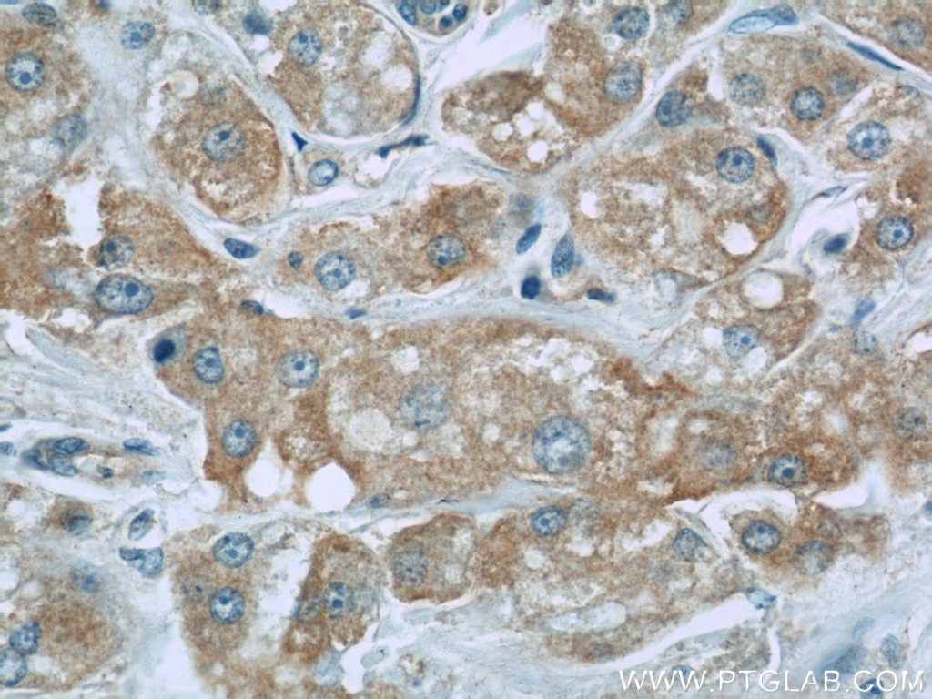 Immunohistochemistry (IHC) staining of human breast cancer tissue using RFP2 Polyclonal antibody (22021-1-AP)