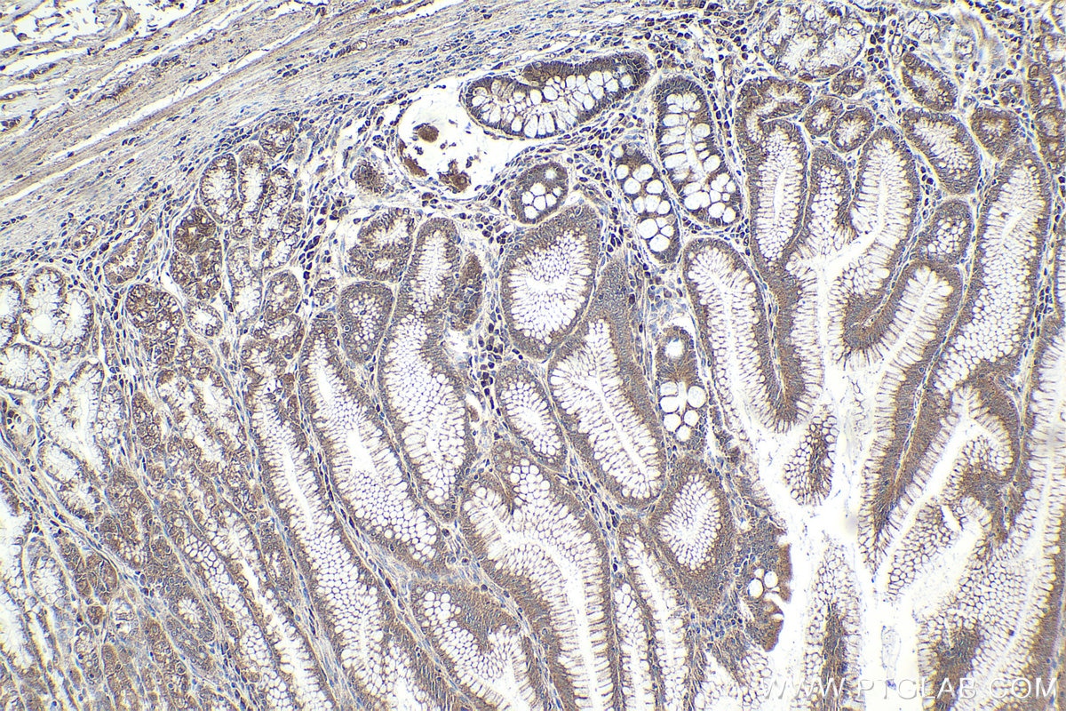 Immunohistochemistry (IHC) staining of human stomach cancer tissue using TRIM15 Polyclonal antibody (13623-1-AP)