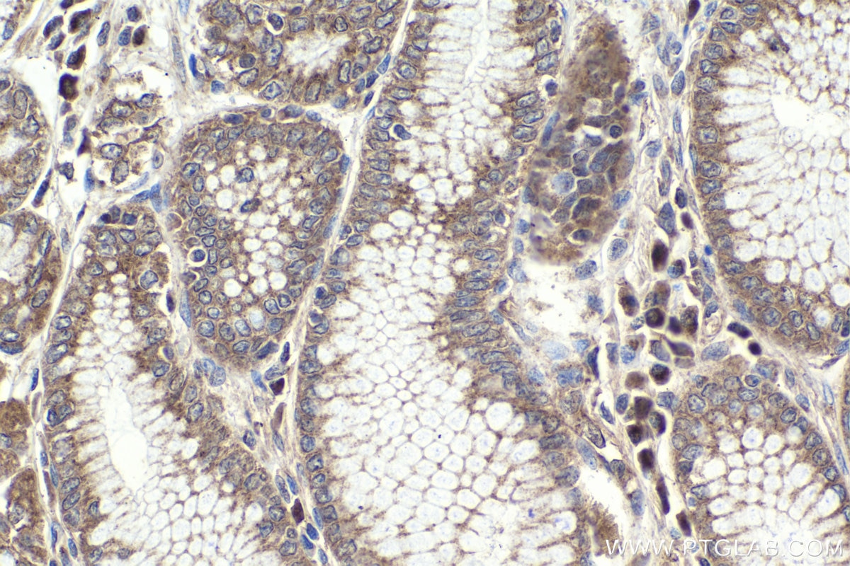 Immunohistochemistry (IHC) staining of human stomach cancer tissue using TRIM15 Polyclonal antibody (13623-1-AP)