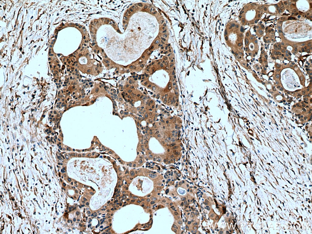 Immunohistochemistry (IHC) staining of human colon cancer tissue using TRIM17 Polyclonal antibody (13663-1-AP)
