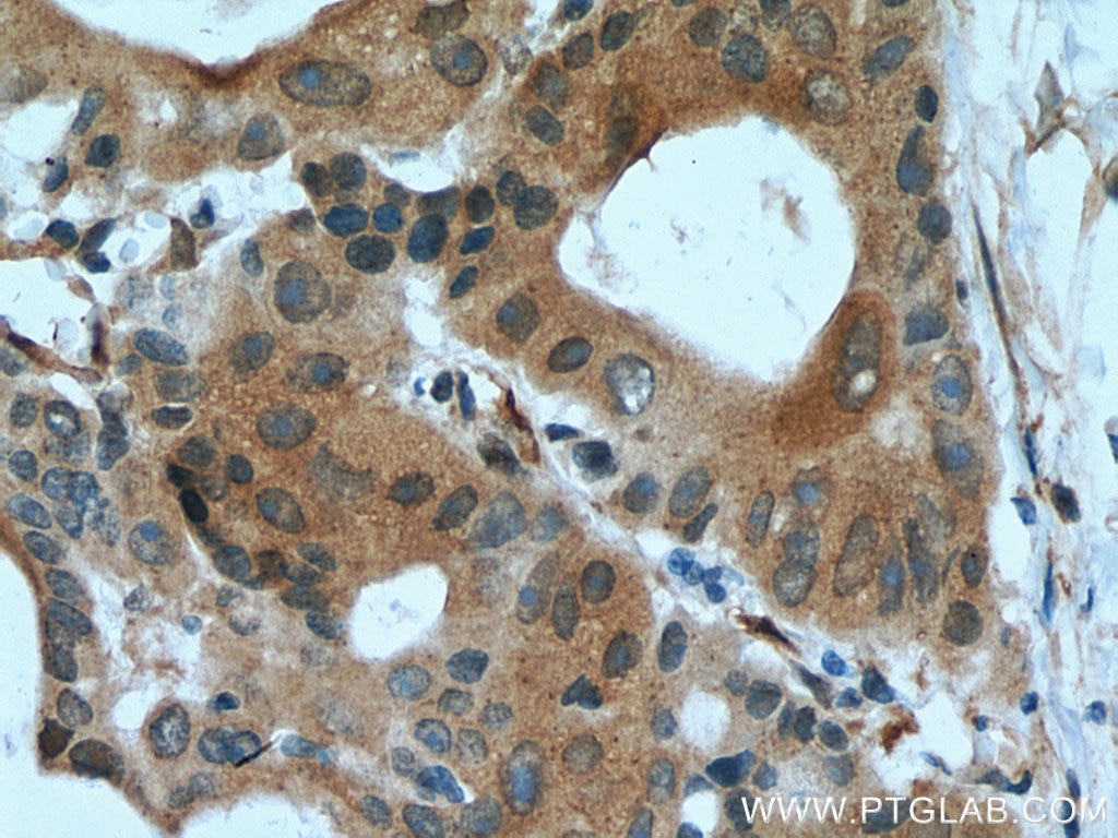 Immunohistochemistry (IHC) staining of human colon cancer tissue using TRIM17 Polyclonal antibody (13663-1-AP)