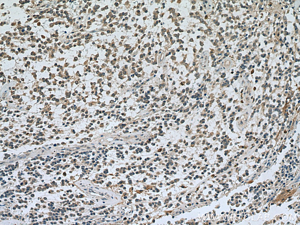 Immunohistochemistry (IHC) staining of human gliomas tissue using TRIM2 Monoclonal antibody (67342-1-Ig)