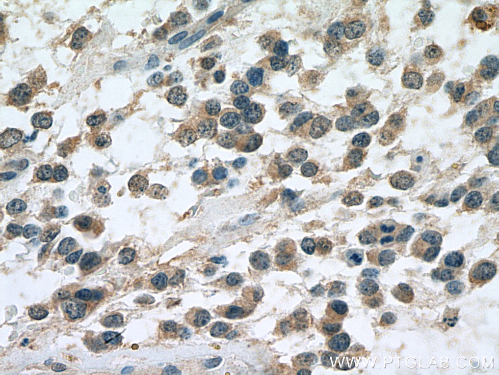Immunohistochemistry (IHC) staining of human gliomas tissue using TRIM2 Monoclonal antibody (67342-1-Ig)